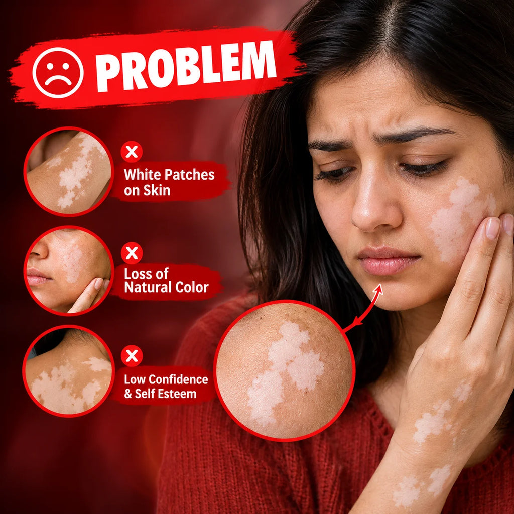 Vitiligo Care Cream