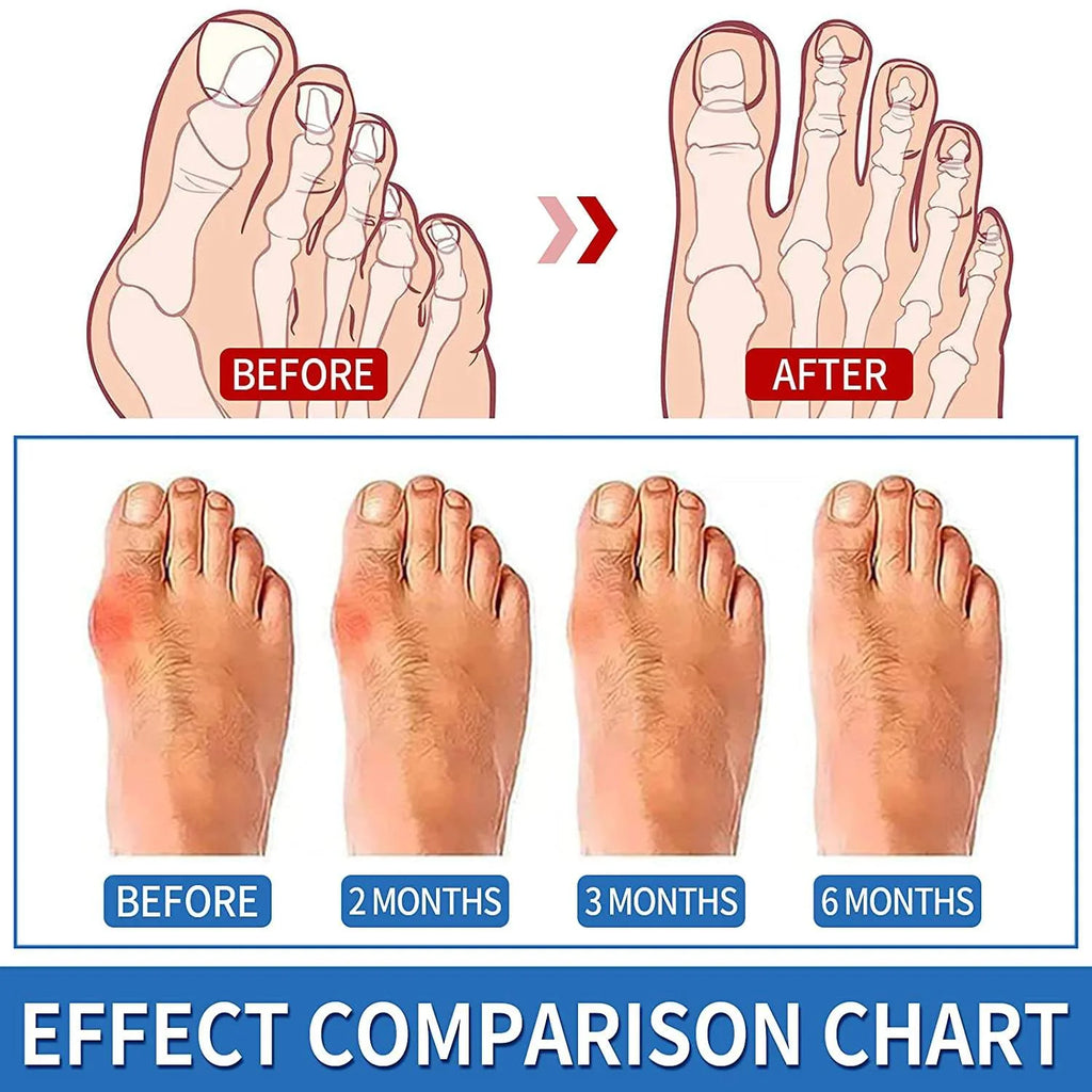 Bunion Aid Hinged Splint
